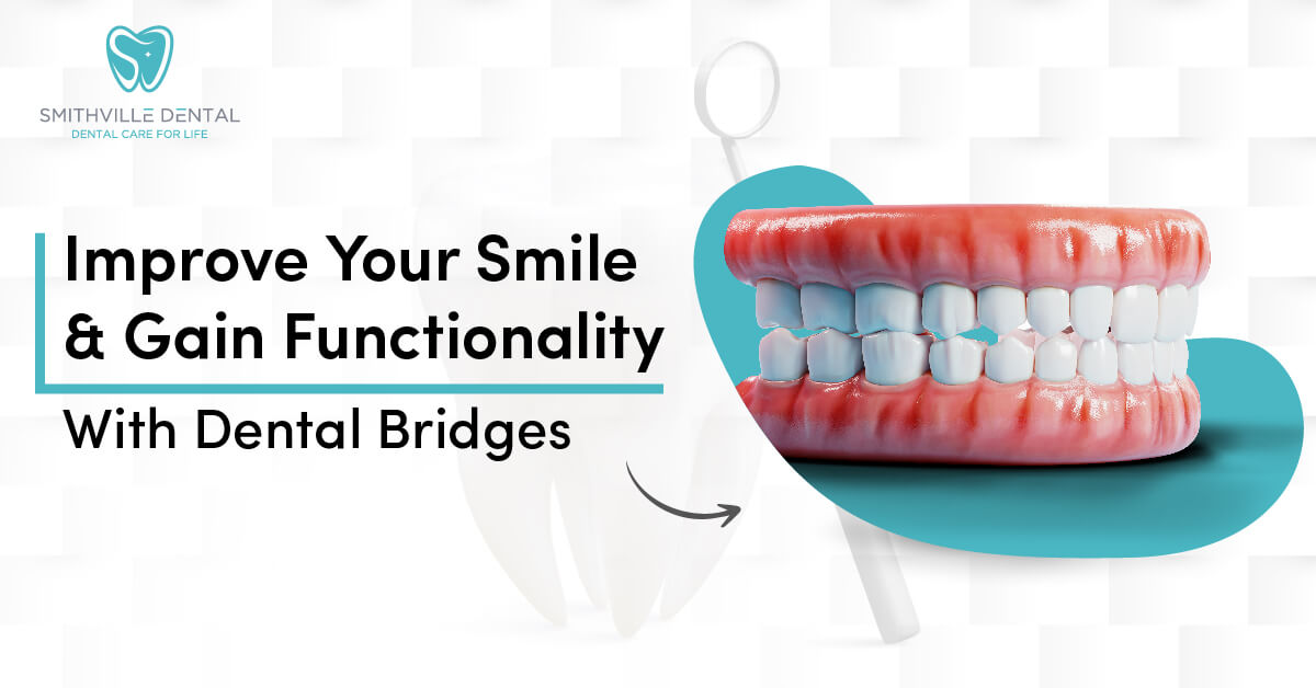 Improve Your Smile and Gain Functionality With Dental Bridges