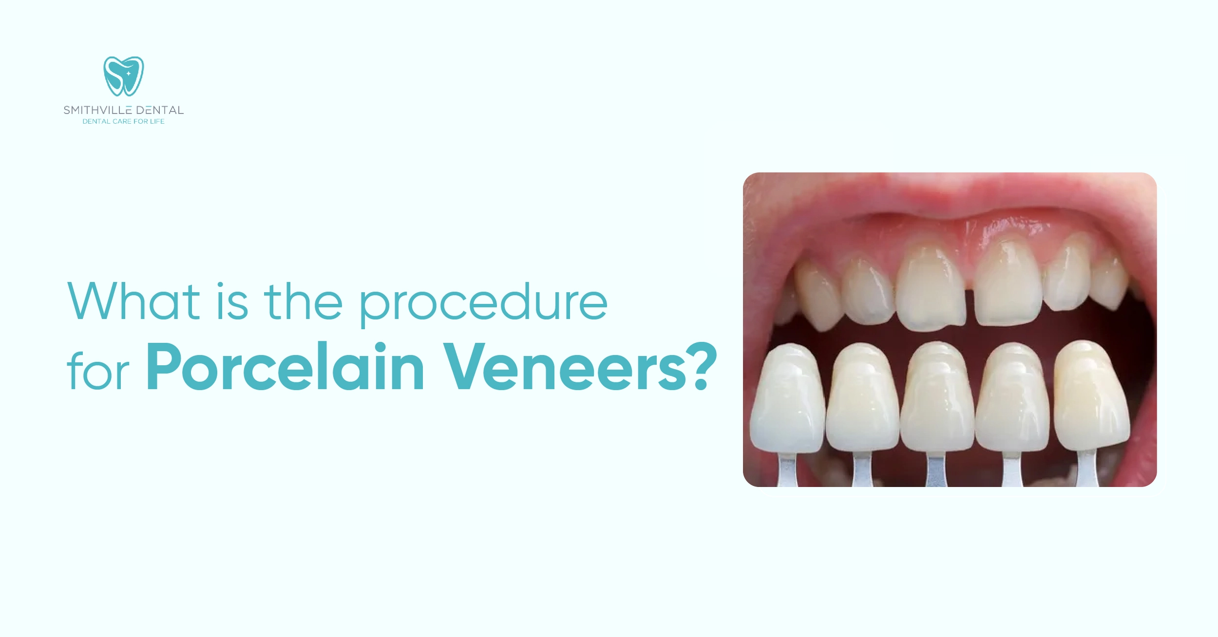 What Is the Process of Porcelain Veneers?