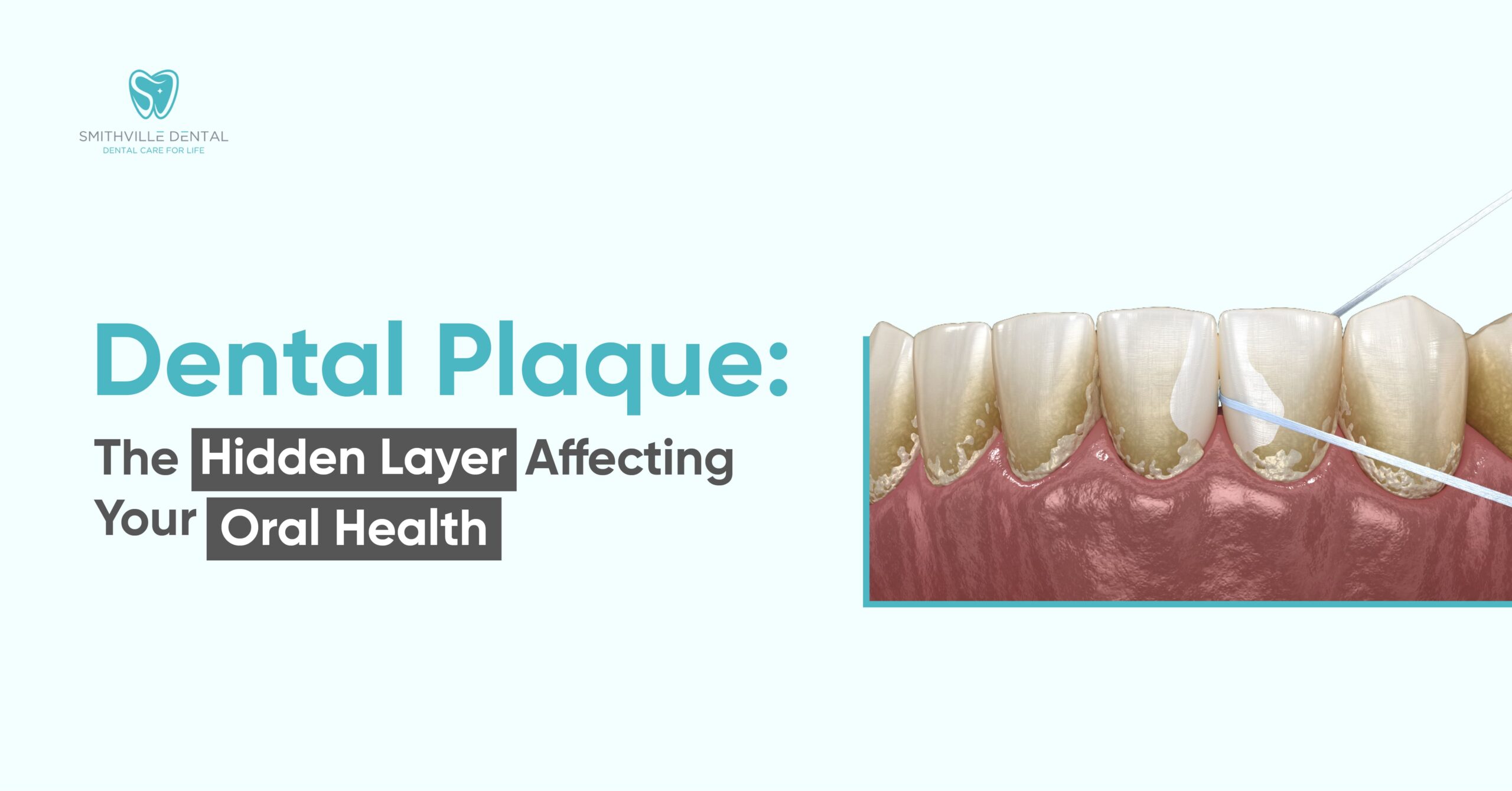 Dental Plaque: The Hidden Layer Affecting Your Oral Health