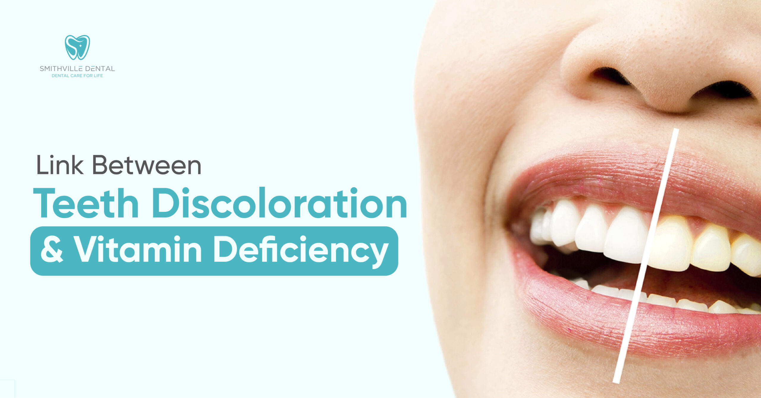 Link Between Teeth Discoloration and Vitamin Deficiency